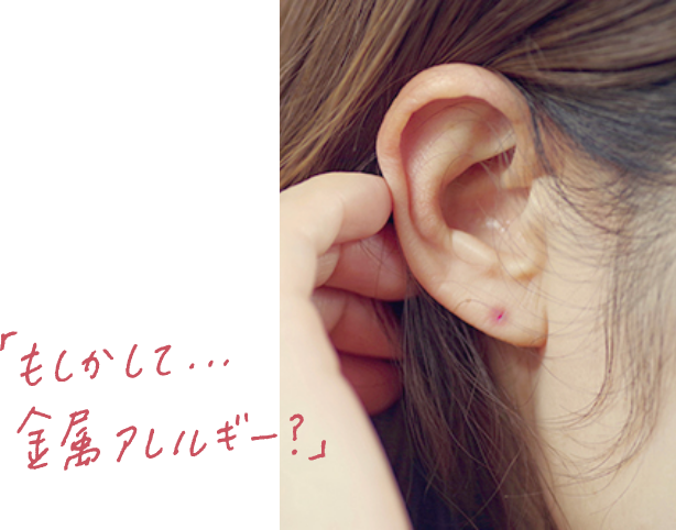 金属アレルギーを起こした女性のピアスホール